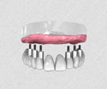 Chirurgie Et Implants Des Ursulines Chirurgien Dentiste Lannion Les Bridges Sur Implant