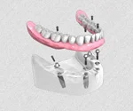 Chirurgie Et Implants Des Ursulines Chirurgien Dentiste Lannion Pose Dun Bridge Complet Sur Implants Dentaires All On 6